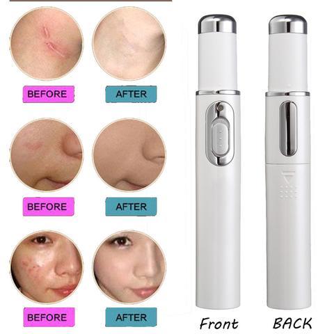 Blue Light Acne Laser Pen