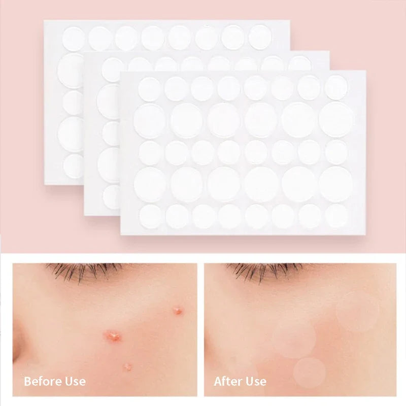 Acne Pimple Patch Invisible Waterproof | Hydrocolloid Spot Treatment for Blemishes